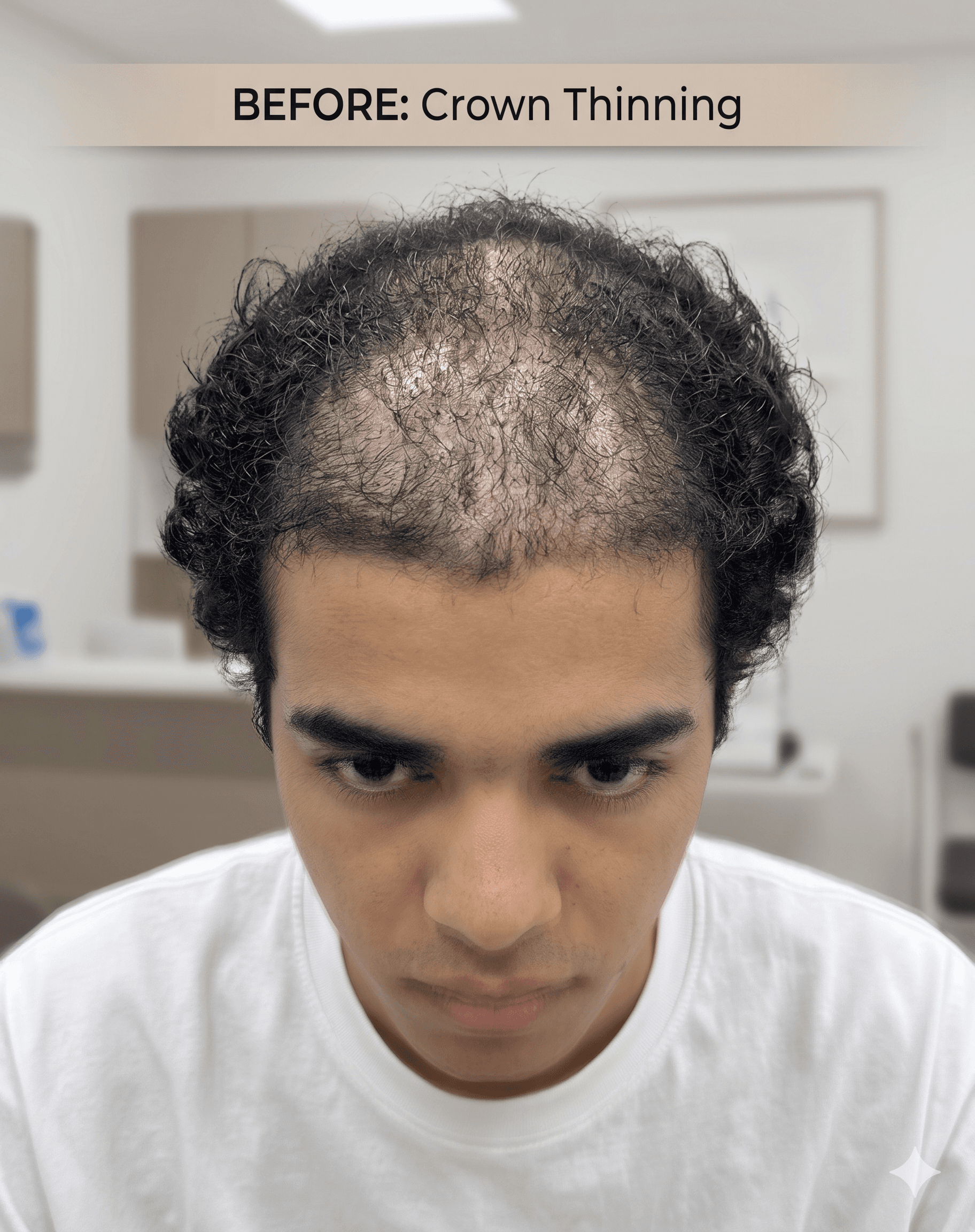 Hair transplant before — hair loss and thinning in Peshawar patient