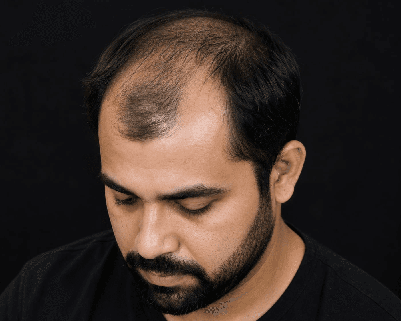 Hair transplant result