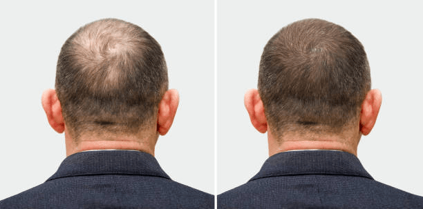 Hair transplant results at Miami Plastic Surgery Peshawar