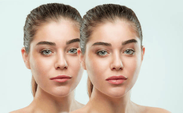 Front brow lift comparison and facial balance