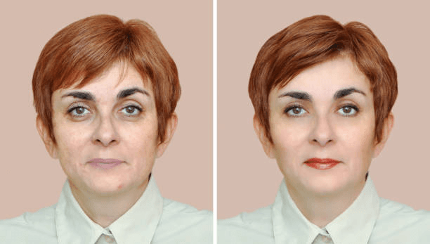 Mature brow lift comparison reference