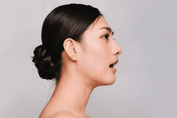 Chin augmentation side profile