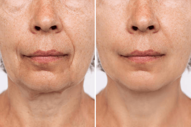 Frontal view Deep Plane Facelift before and after โ facial symmetry and harmony