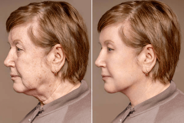 Natural-Looking Facelift Results