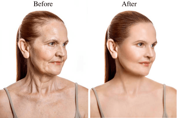 Deep Plane Facelift in Miami