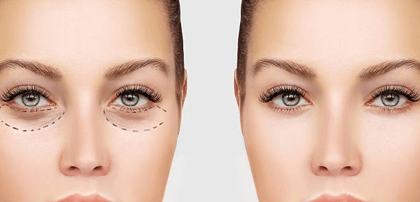 Lower eyelid planning comparison for under-eye bags