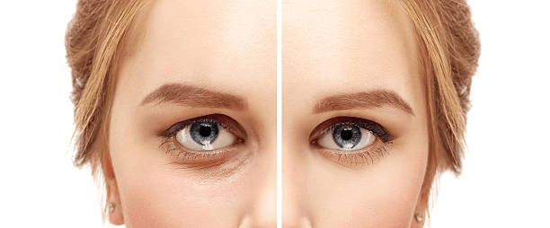 Under-eye softening comparison reference for lower eyelid surgery