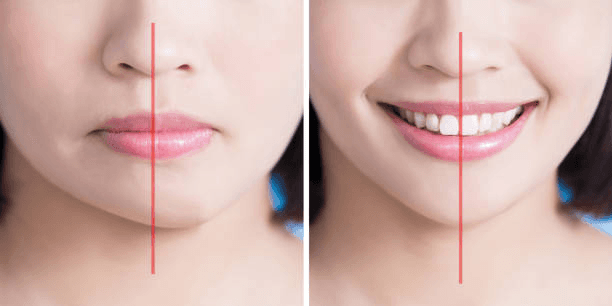 Upper Lip Lift in Peshawar lip proportion analysis