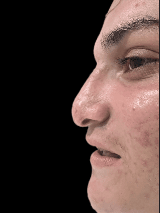 Bridge Irregularity before revision rhinoplasty Peshawar