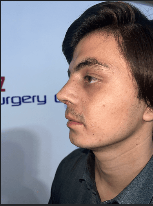 Overall Proportion after revision rhinoplasty Peshawar