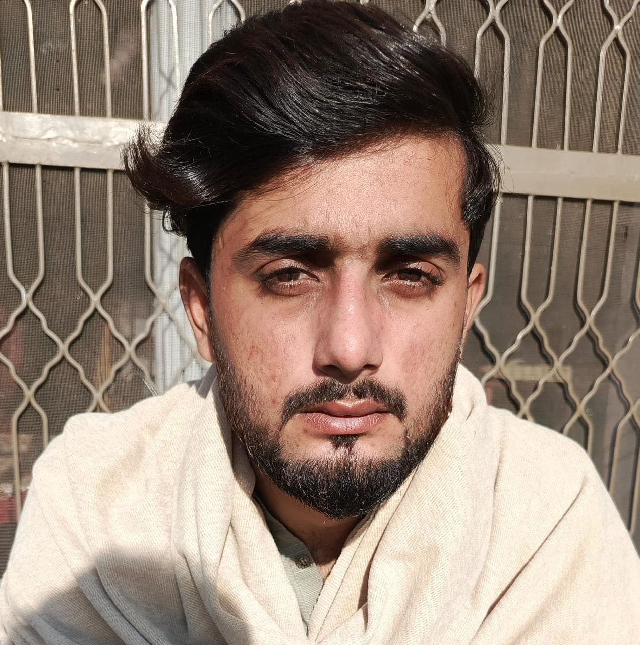 Tip Asymmetry after revision rhinoplasty Peshawar