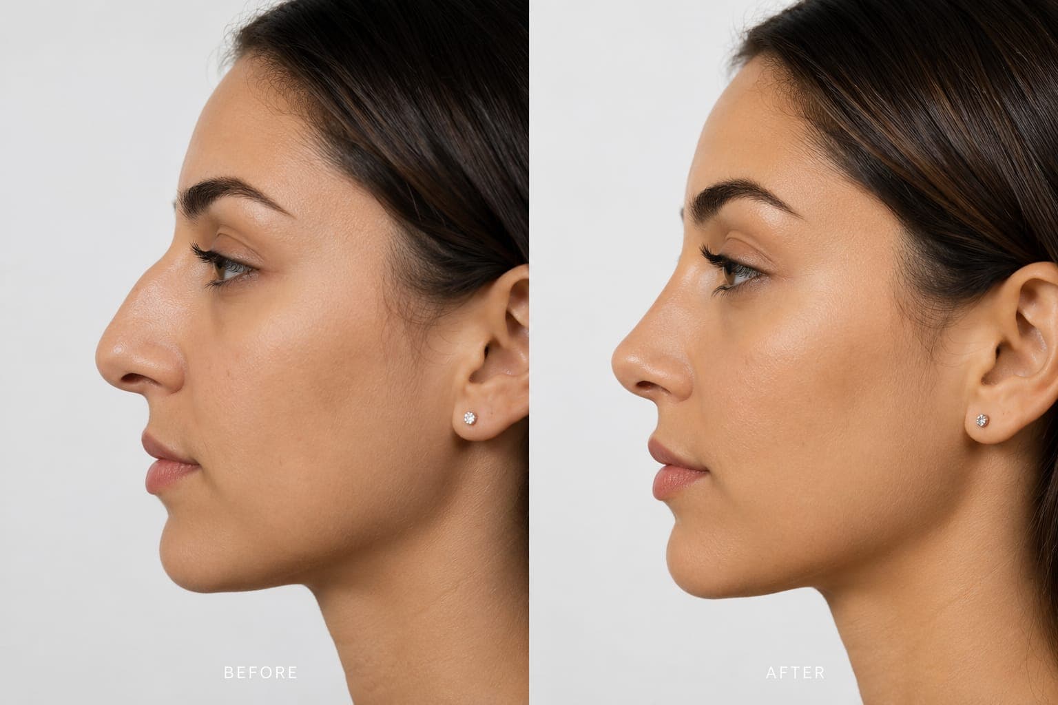 Rhinoplasty in Peshawar