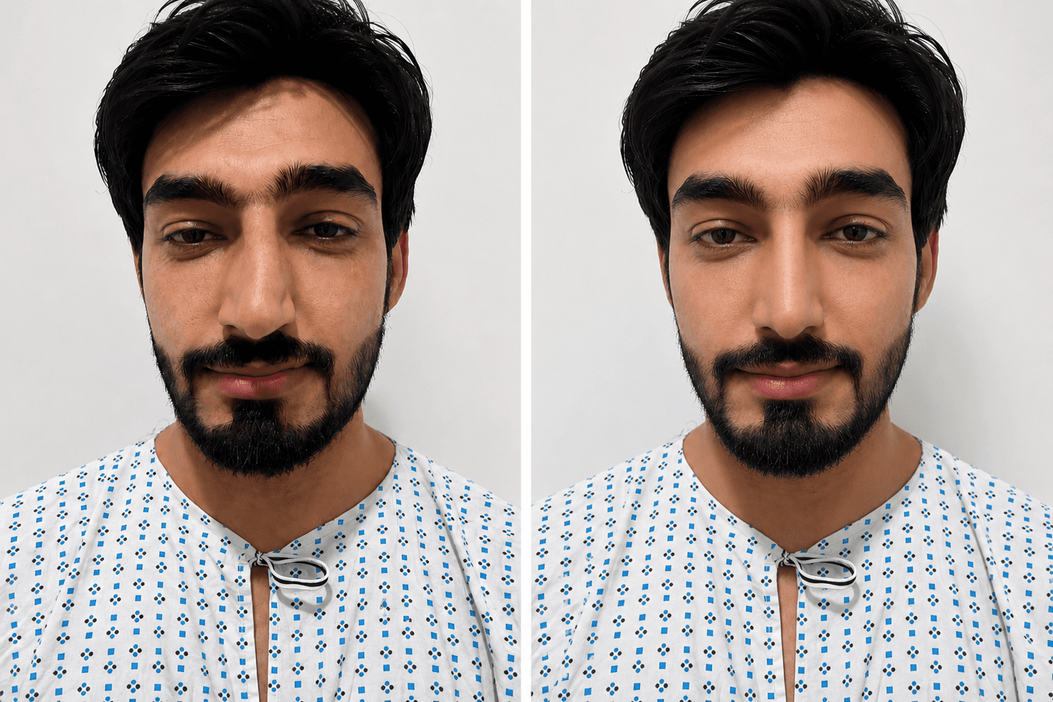 Rhinoplasty nose reshaping result — Miami Plastic Surgery Peshawar