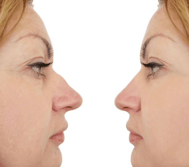 Rhinoplasty consultation at Miami Plastic Surgery Peshawar