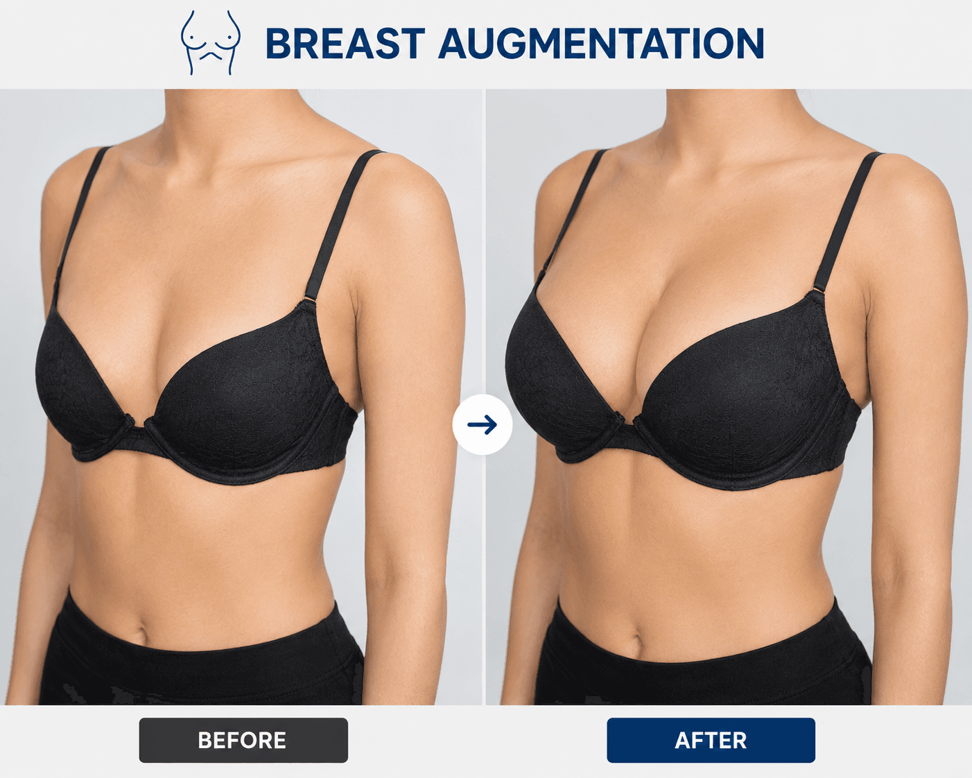 Breast Lift (Mastopexy) – breast surgery Miami clinic Peshawar