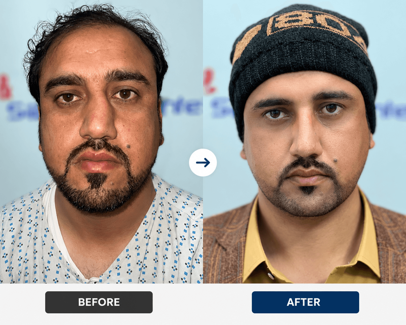 Facial plastic surgery – rhinoplasty facelift blepharoplasty Peshawar