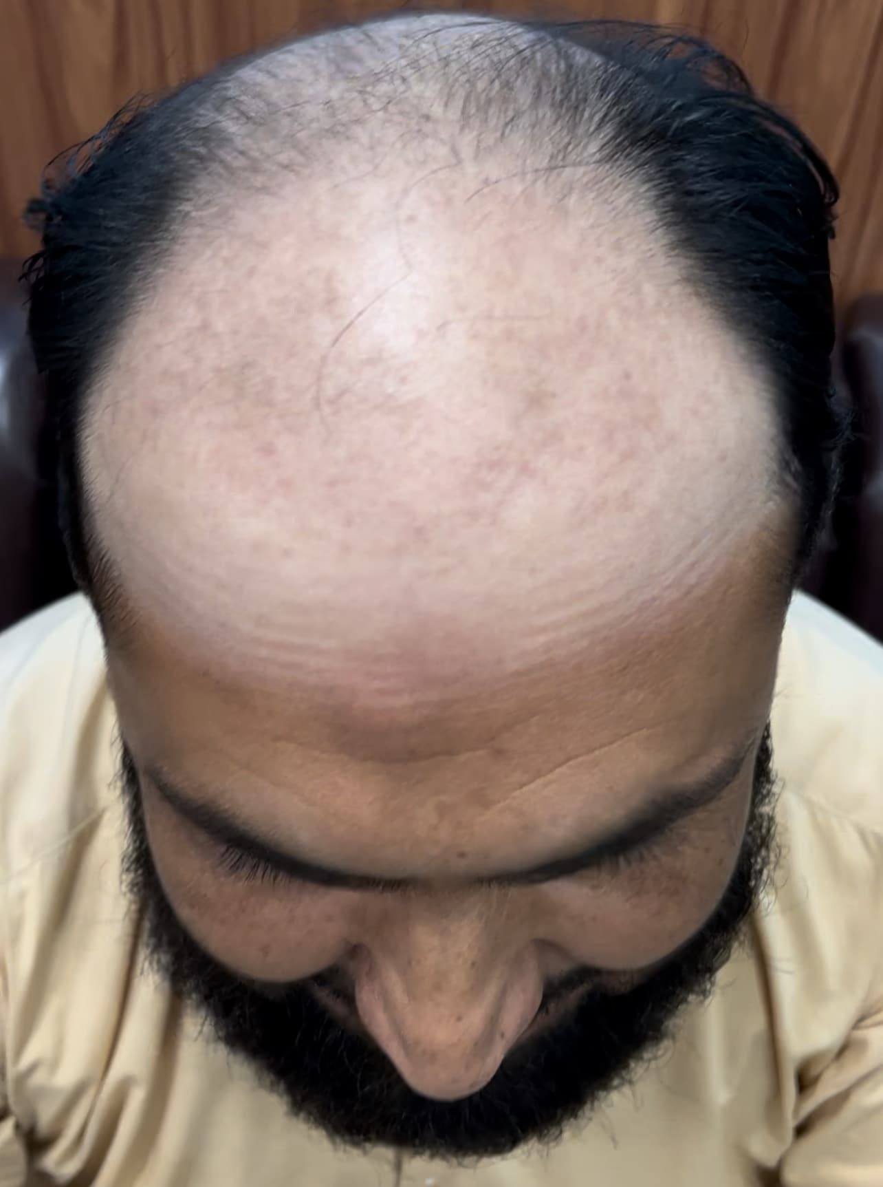 Hair Restoration before