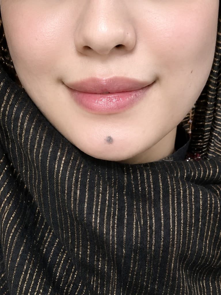 Dimpleplasty before cheek enhancement