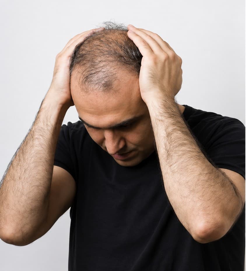 Hair transplant before crown thinning