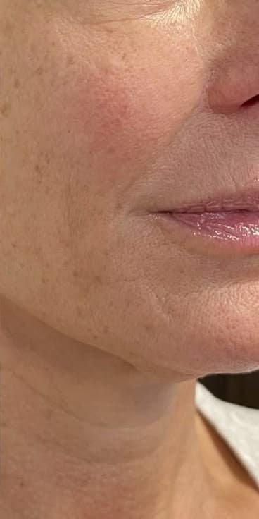 Skin tightening after smoother lower face texture